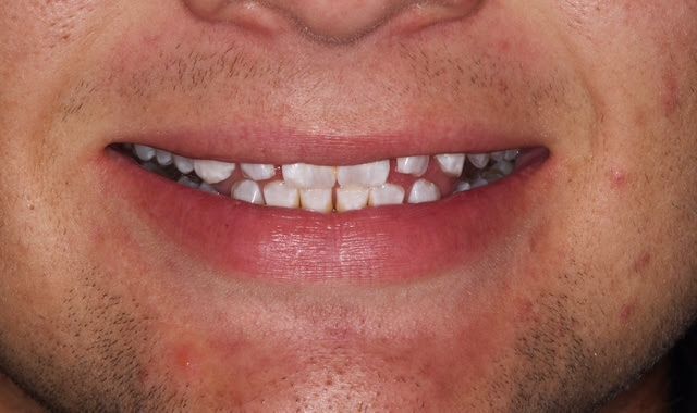 Close-up of a smiling mouth with visible teeth and slight acne on the cheeks