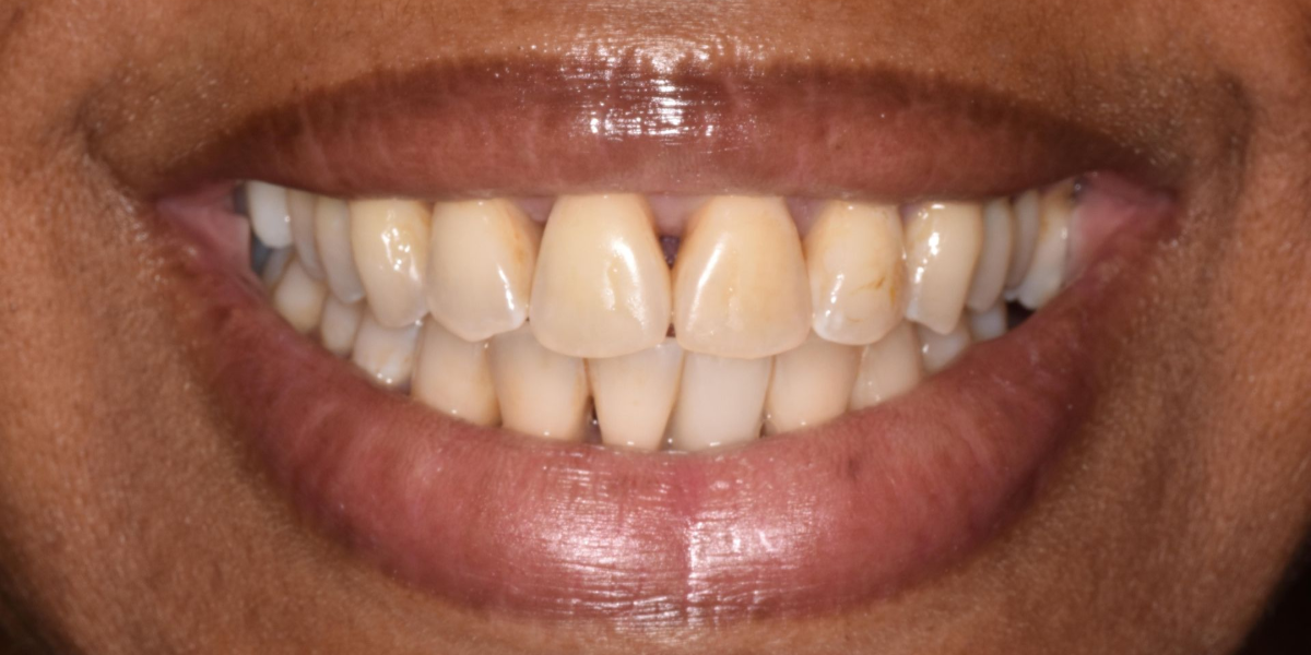 Close-up of a smiling mouth showing teeth with a noticeable gap between the front teeth