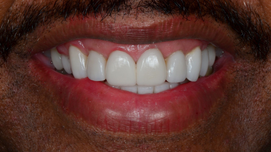 Smile Savers Dentistry Columbia MD Teeth Whitening After