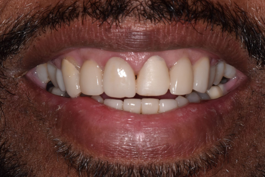 Smile Savers Dentistry Columbia MD Teeth Whitening Before