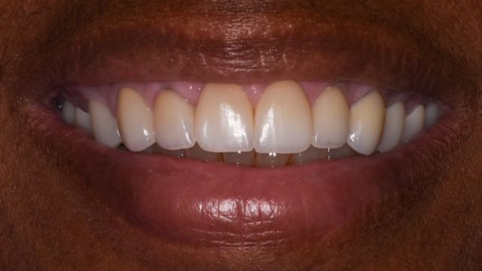 Smile Savers Dentistry Columbia MD Veneers After