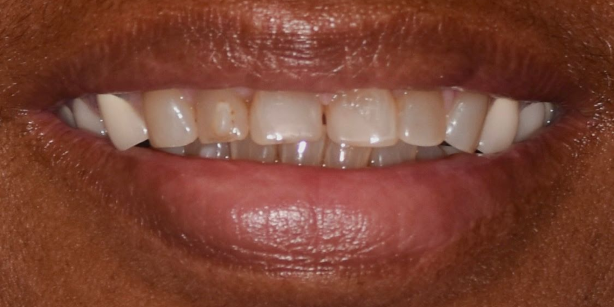 Smile Savers Dentistry Columbia MD Veneers Before