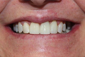Close-up of a person's smile with straight, white teeth and red lips.