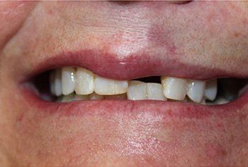 Close-up of a person's mouth with a missing front tooth; lips are slightly parted, revealing teeth and gums.