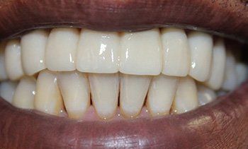 Close-up of mouth with white, straight upper teeth and slightly yellowed lower teeth.