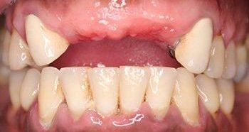 Close-up of human teeth, showing gaps, discoloration, and receding gums.