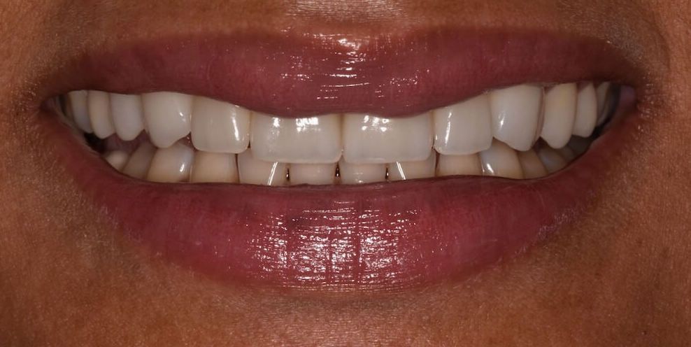 after invisalign