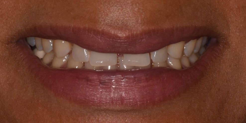 before invisalign