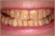before invisalign