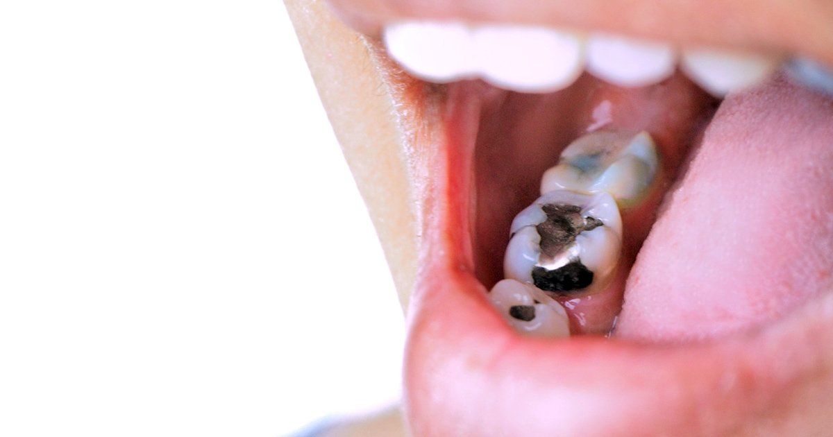 dental cavities, dentist in Columbia MD, dentist Columbia MD