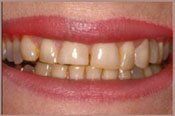teeth before invisalign