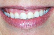 teeth before invisalign