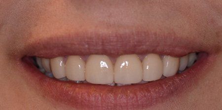 teeth after invisalign