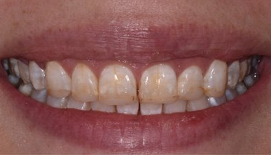teeth before invisalign