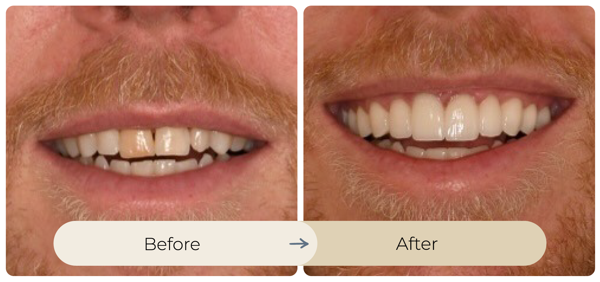 Before and after photo of a man's teeth, showing a change from discolored to bright white teeth.