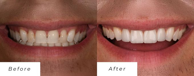 A before and after picture of a person's teeth