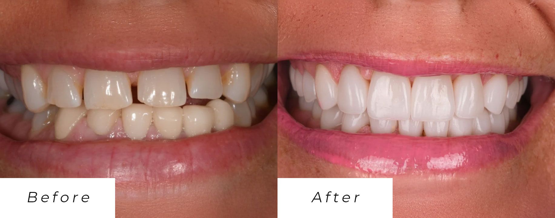 A before and after picture of a woman's teeth