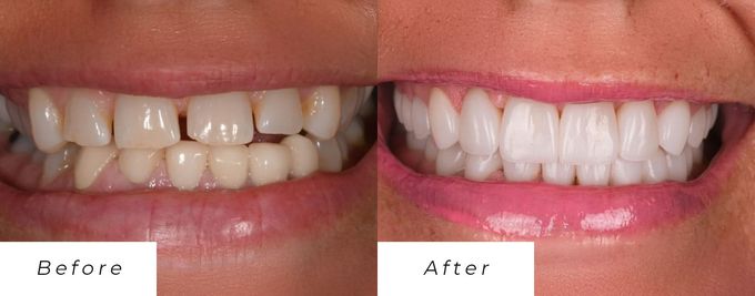 A before and after picture of a woman's teeth