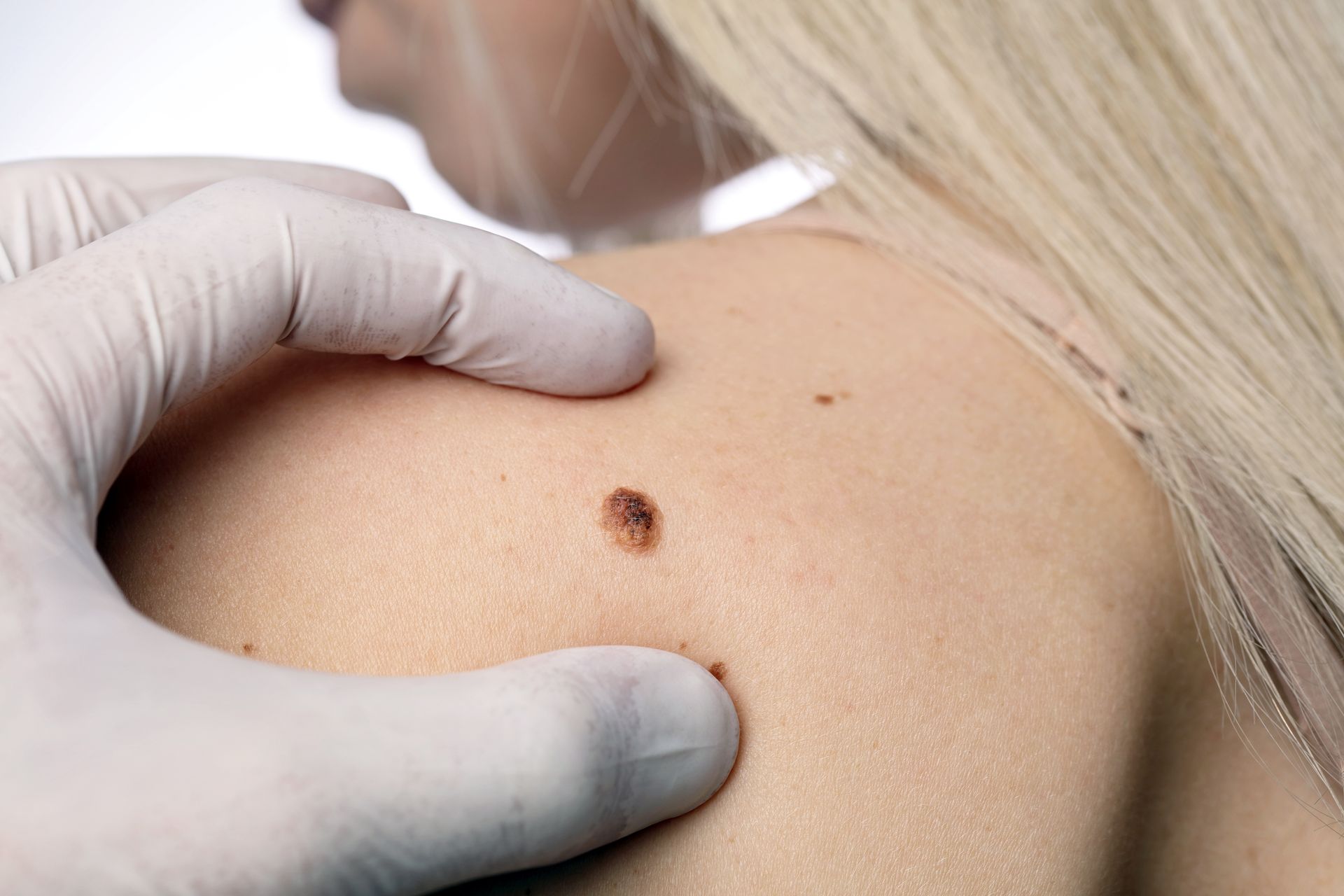Esame dermatologico cute - Dermatologa Brembate Bergamo