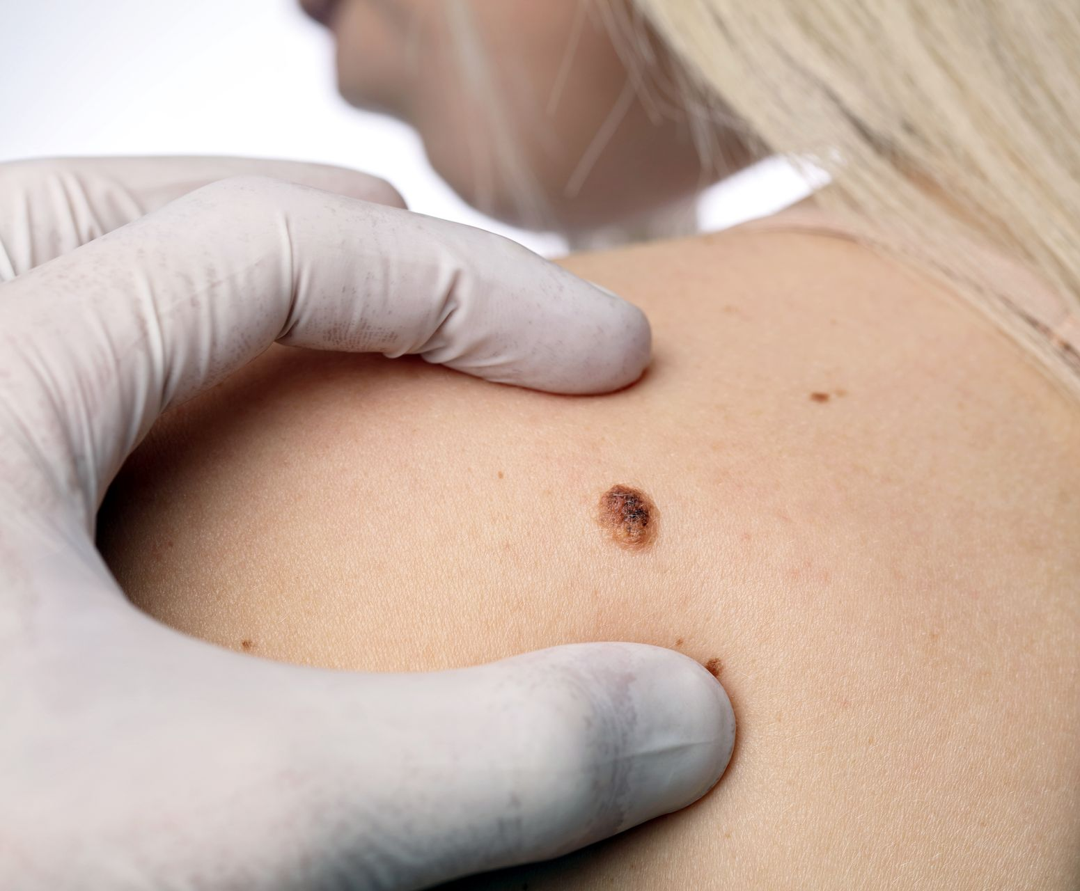 Visita dermatologica controllo neo - Dermatologia Brembate Bergamo