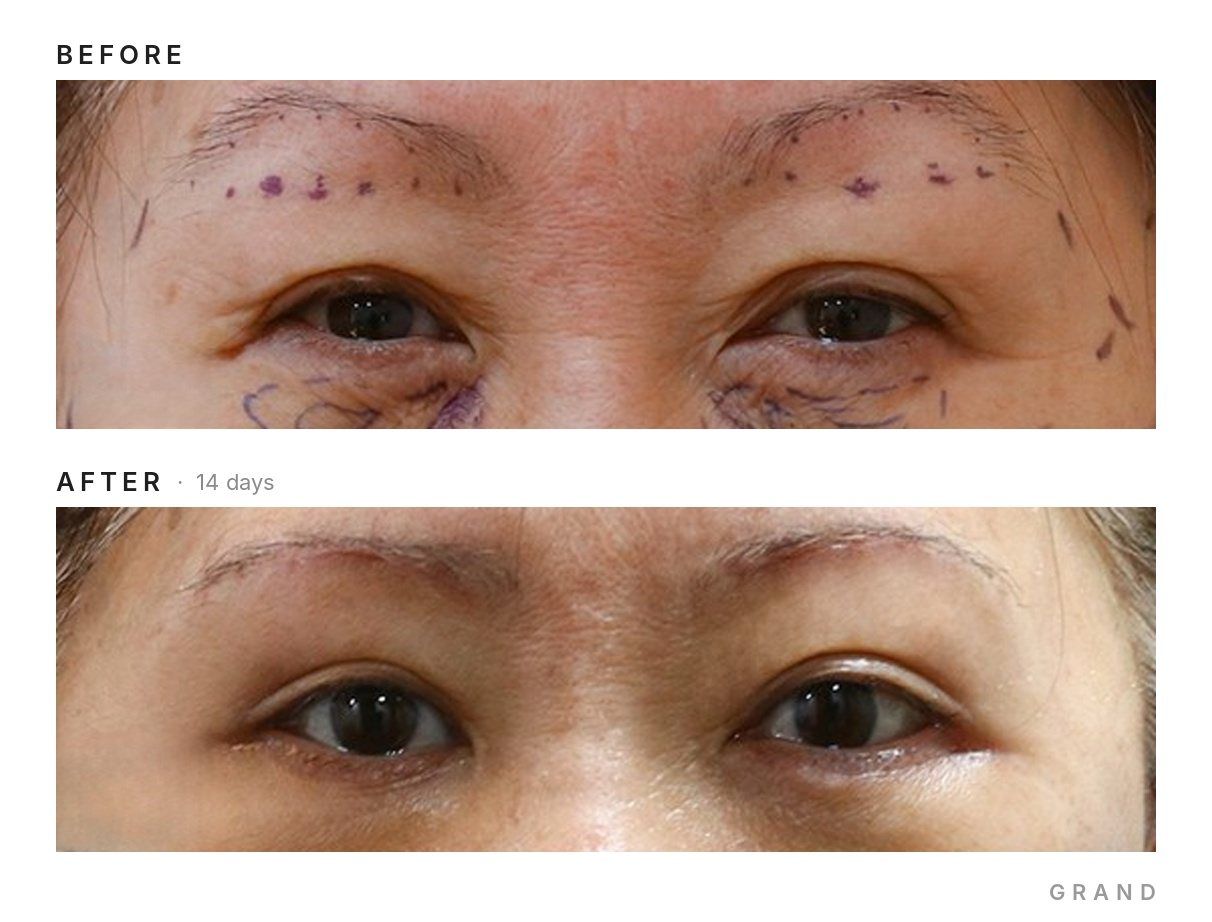 Eyelid surgery before and after at Grand Plastic Surgery Seoul