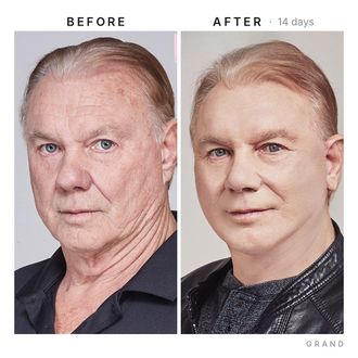 Deep plane facelift before and after