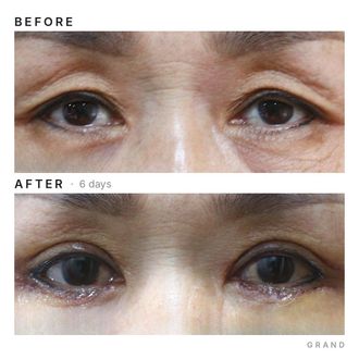 Eyelid surgery before and after
