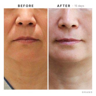 Neck lift before and after