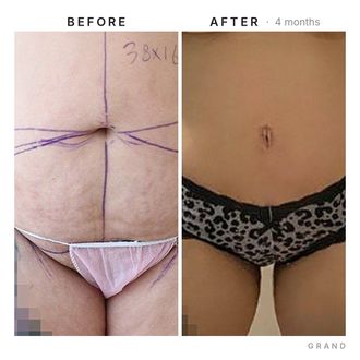 Tummy tuck before and after