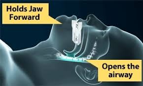 Sleep Apnea Treatments Sleep Apnea Treatments