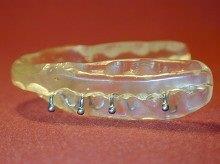 Clear mouthguard with metal hooks, likely for dental appliance use, against a red background.