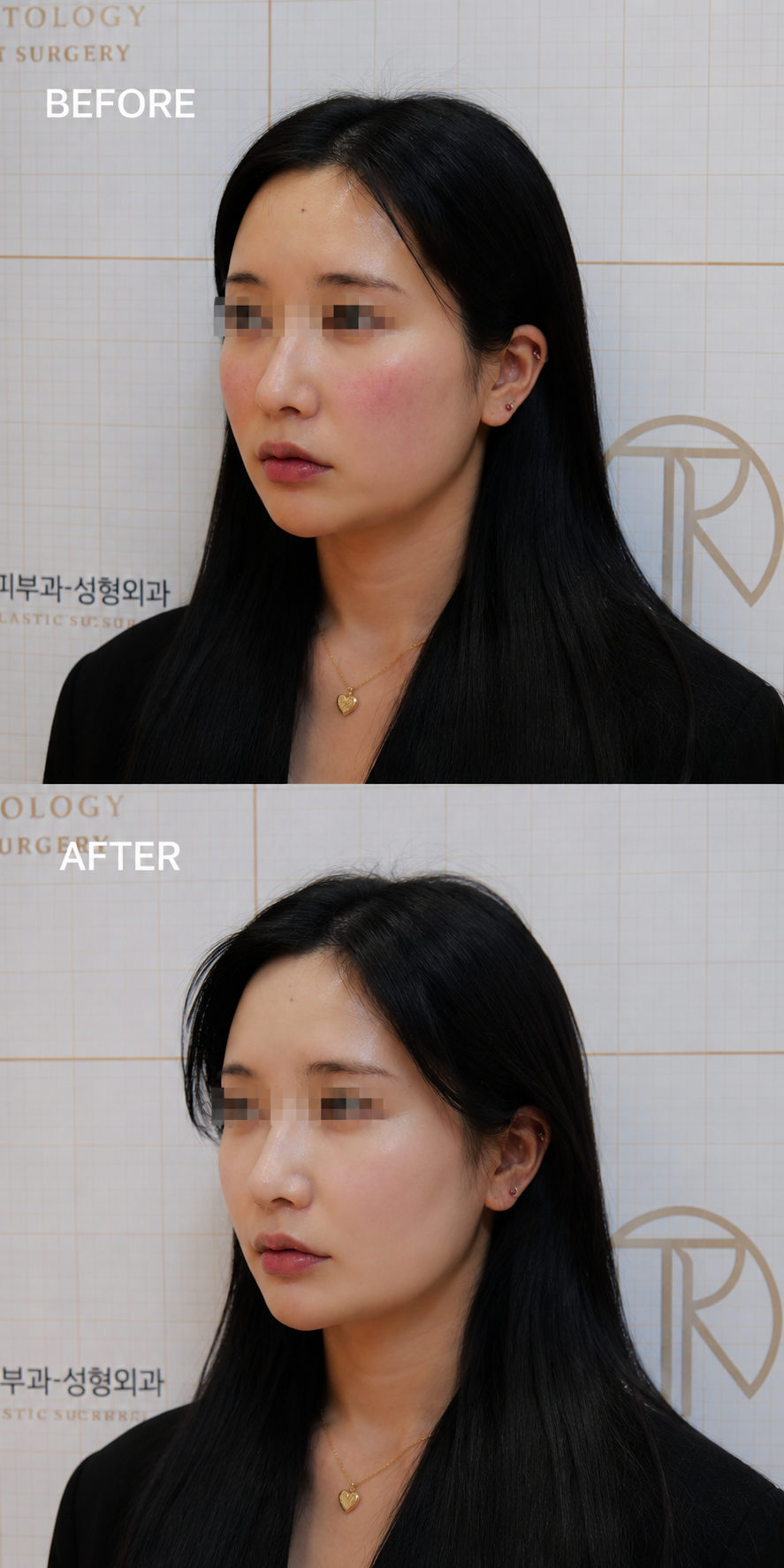 Facial Redness and Tone — before and after, JRYN Dermatology Seomyeon Busan