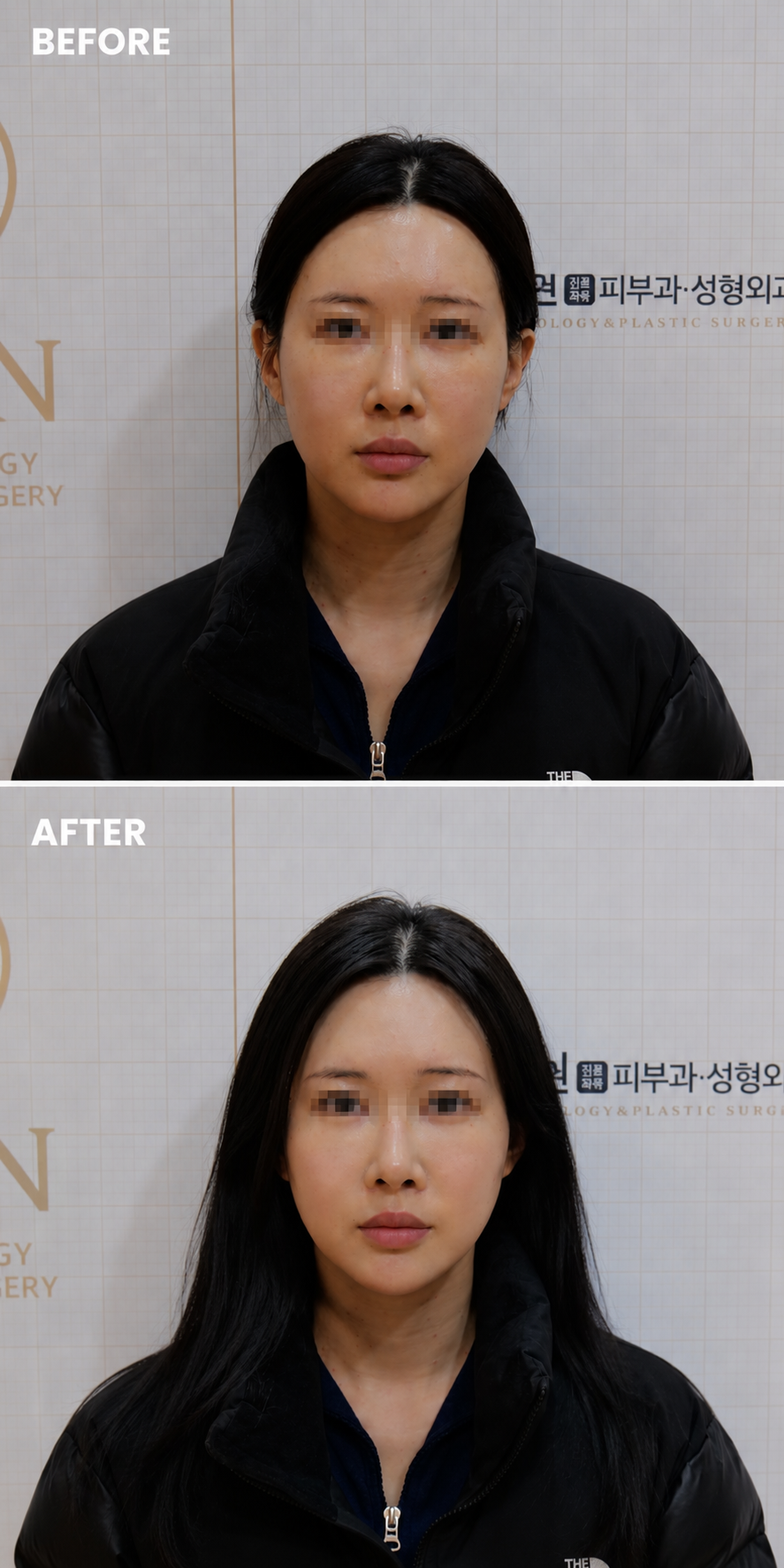 Jawline and V-Line Lift — before and after, JRYN Dermatology Seomyeon Busan