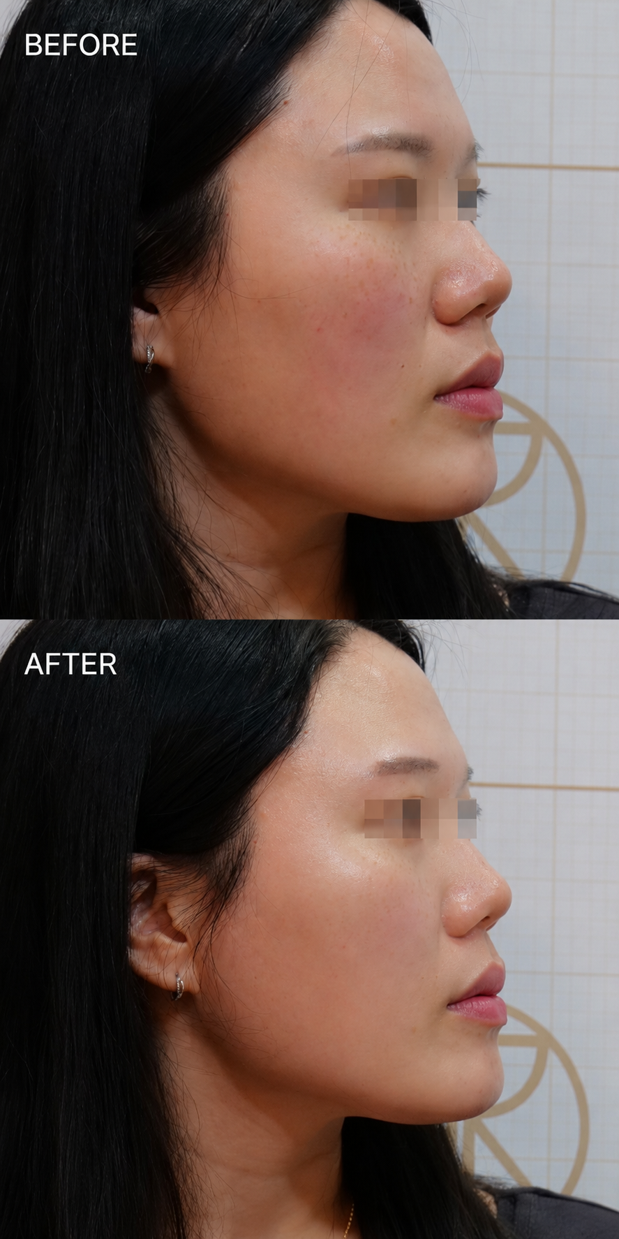 Pore and Texture Refinement — before and after, JRYN Dermatology Seomyeon Busan