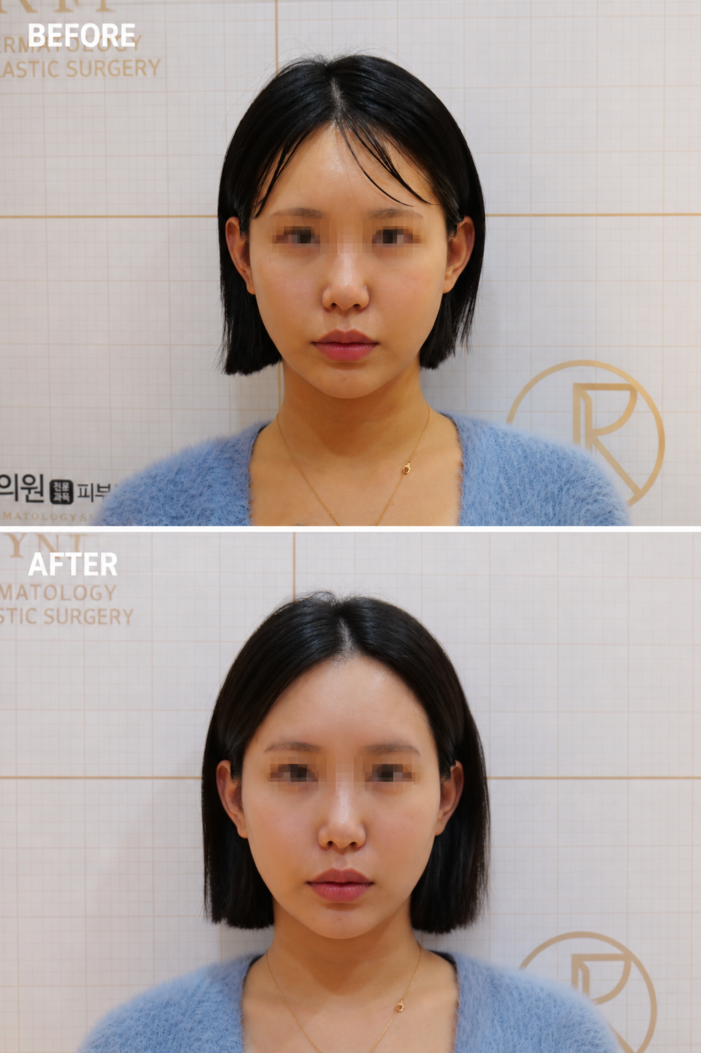Jaw Contour and Lift — before and after, JRYN Dermatology Seomyeon Busan