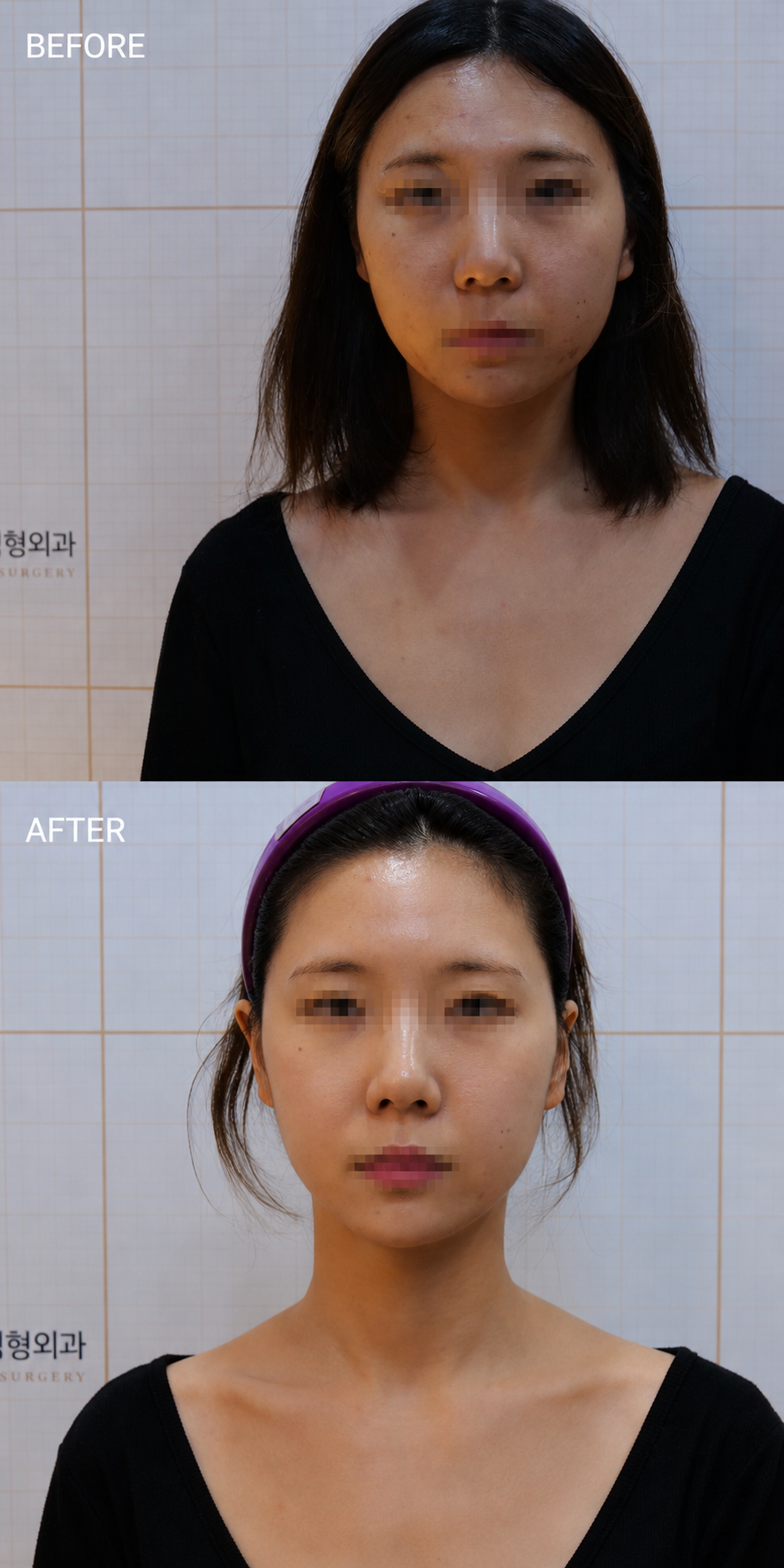 Blemish and Pigment Clearing — before and after, JRYN Dermatology Seomyeon Busan