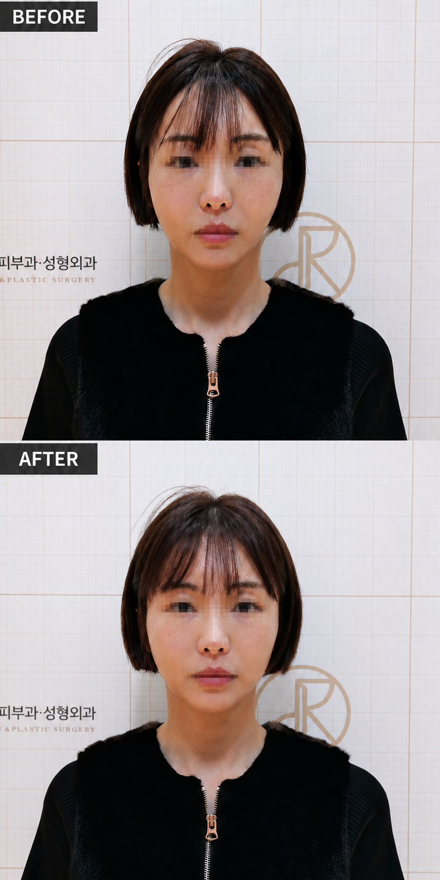 Brightening and Texture — before and after, JRYN Dermatology Seomyeon Busan