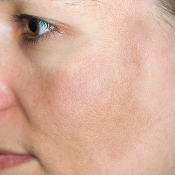 Close-up of a person's cheek and eye with a small red blemish on the skin