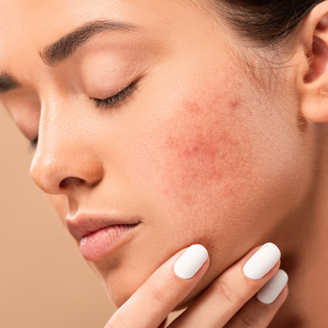 Close-up of a face with red acne spots on the cheek, gently touching the jawline