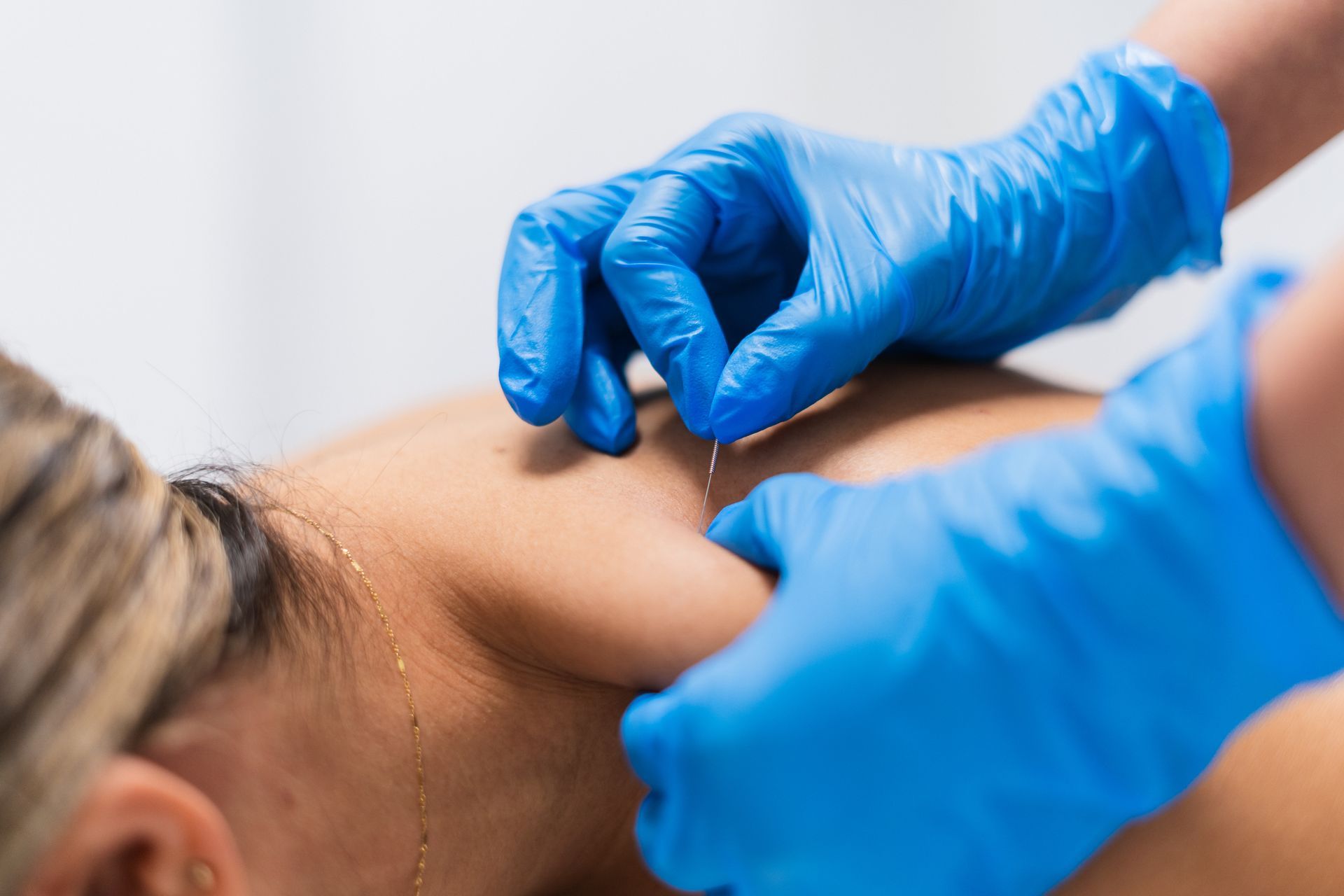Gloved hands threading a needle into a person’s skin during a cosmetic procedure.