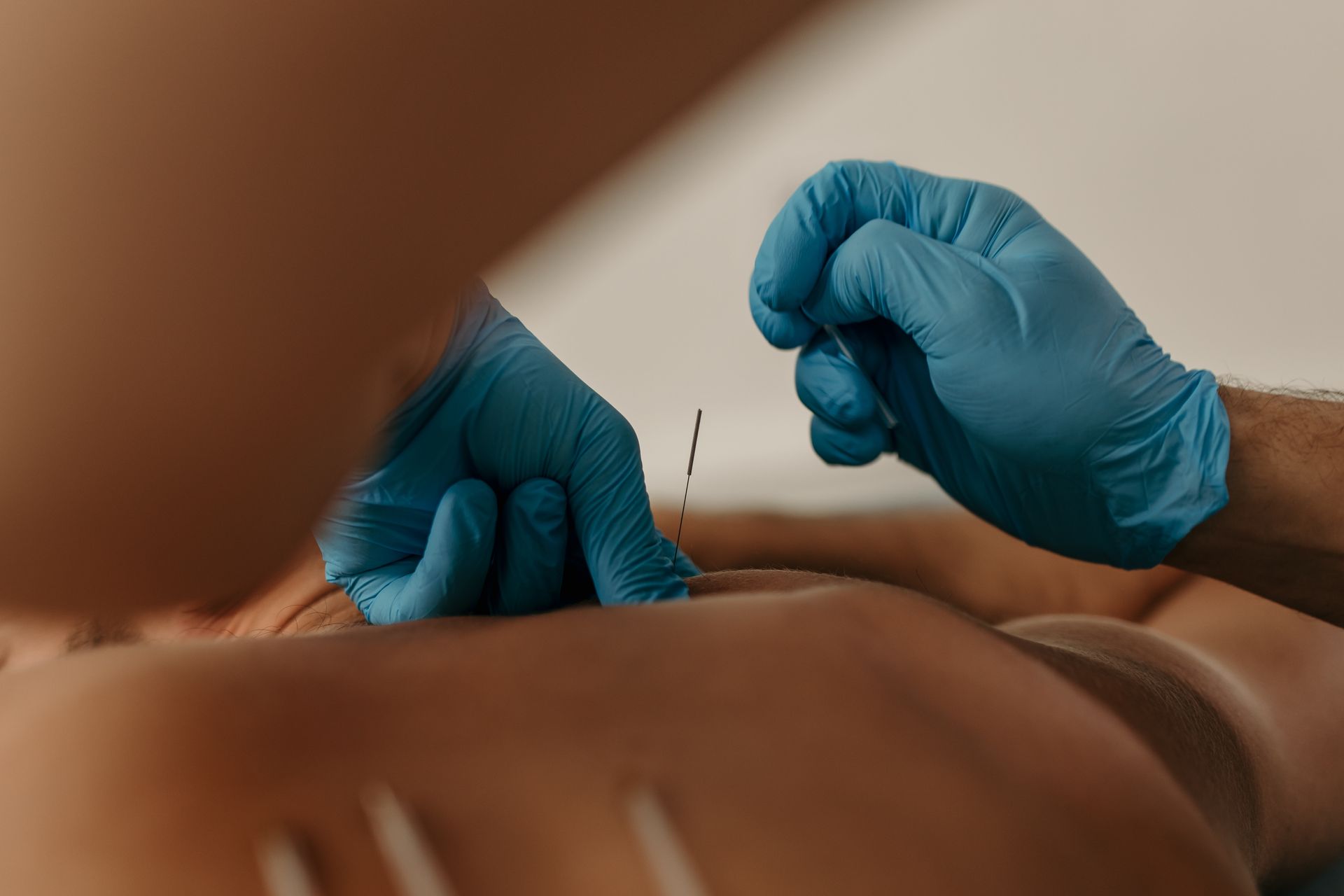 Blue-gloved hands insert a needle into a person’s skin during a medical procedure.