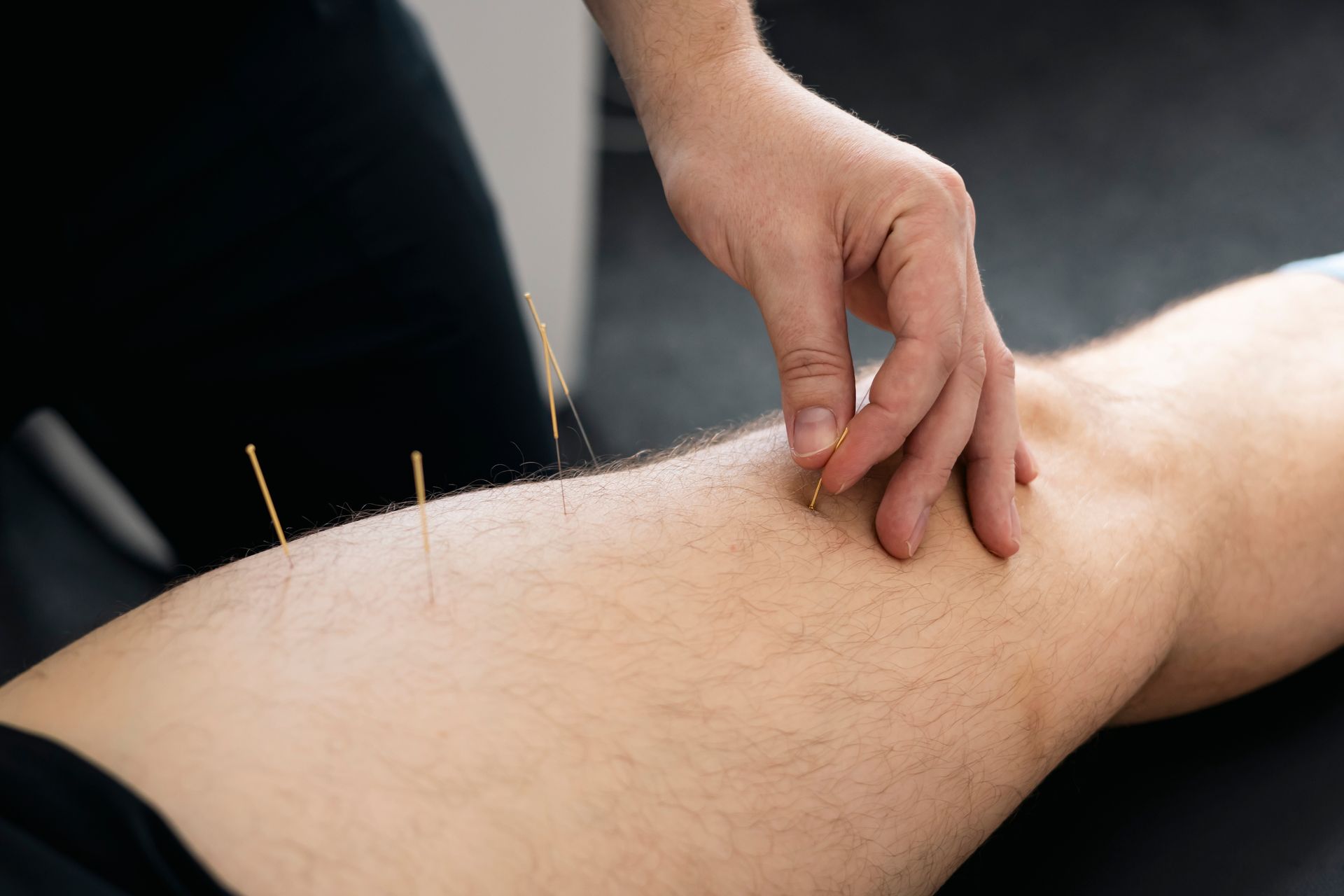 Hand-placing acupuncture needles into a patient’s leg.