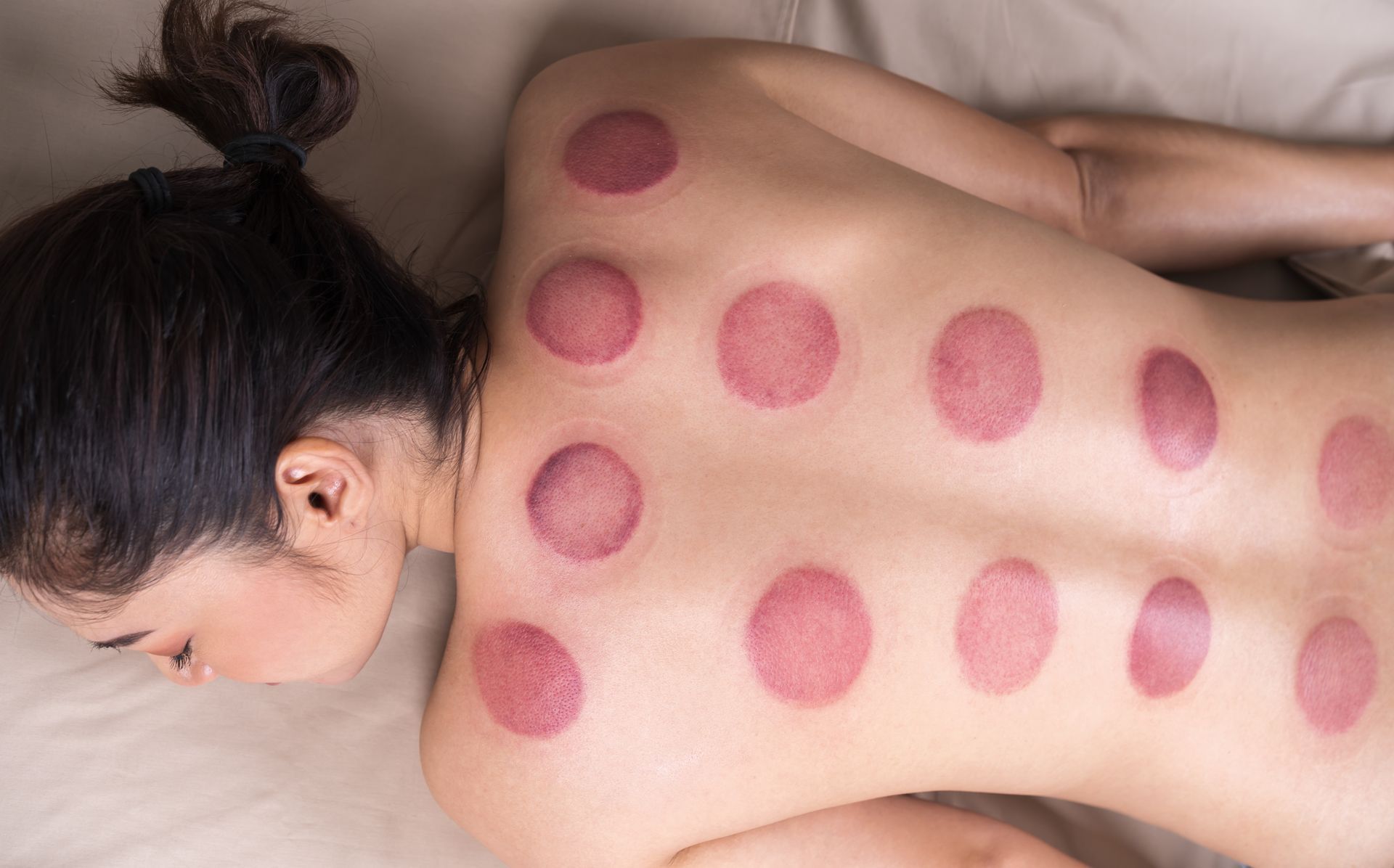 Person lying face down with red circular cupping marks across their back.