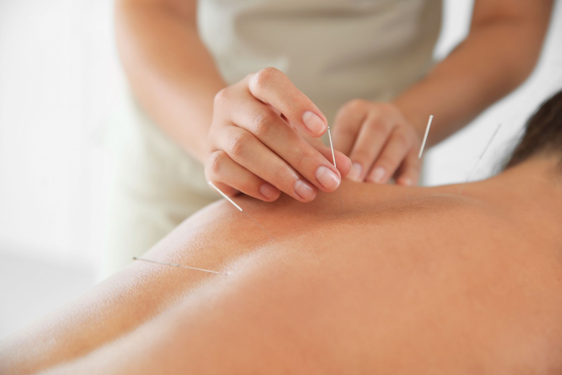 A woman is getting acupuncture on her back for help with fertility