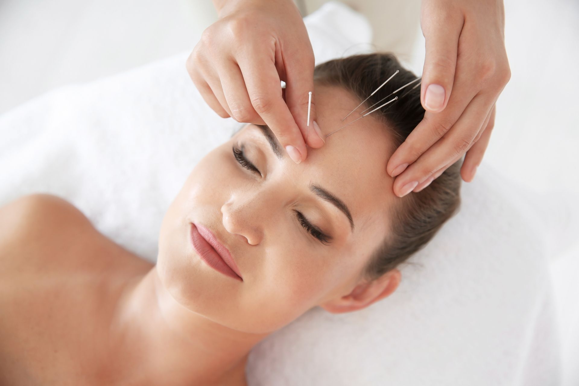 A woman is getting an acupuncture treatment on her forehead to help with IUI