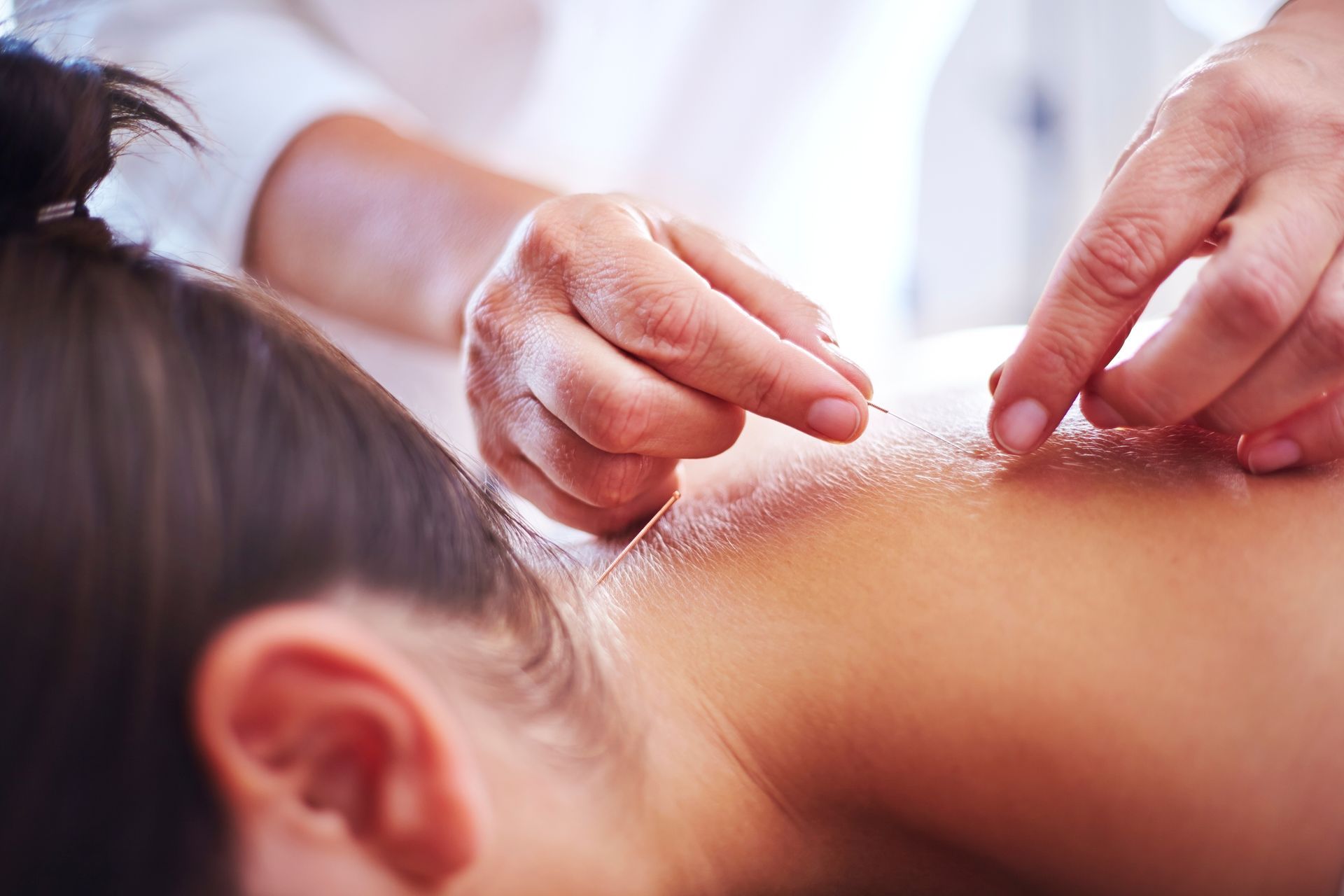 acupuncturist using acupuncture on a young woman to help improve the success rate of IVF