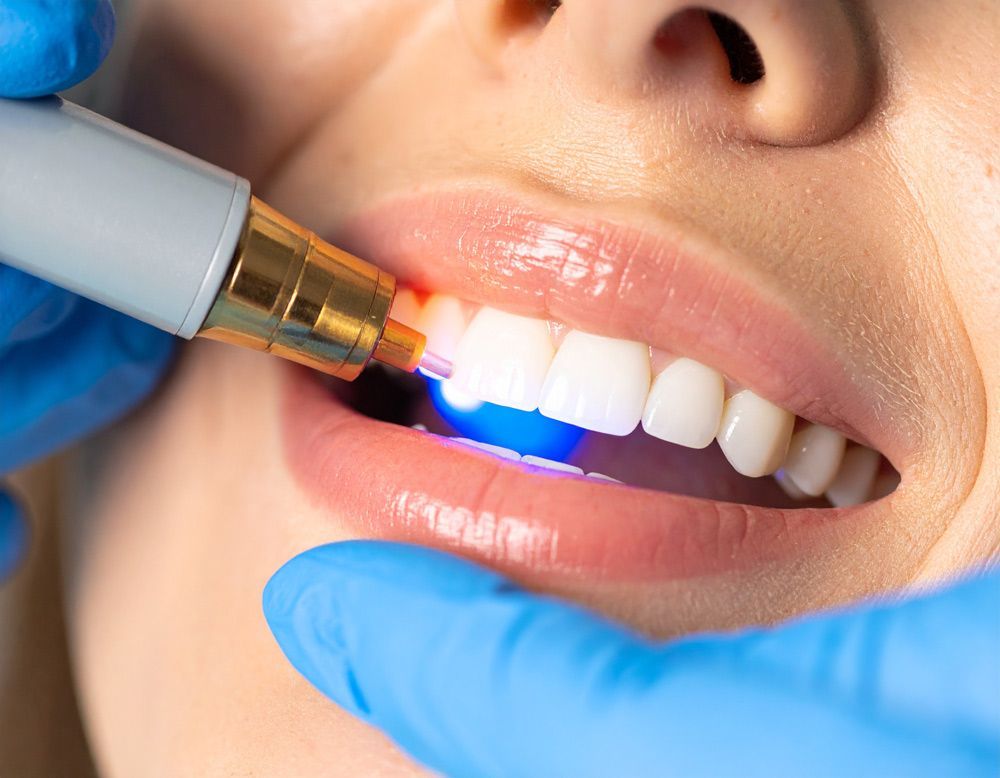 Dental bonding procedure in Meridian, ID