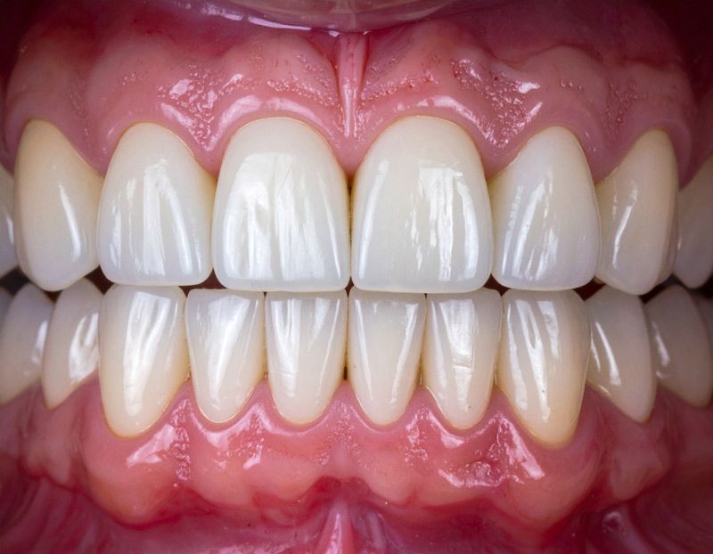 Dental crowns in Meridian, ID