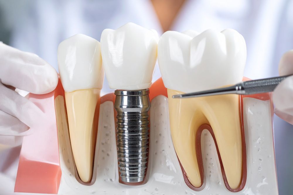 Dental model with tooth implant, showing root, crown, and surrounding tissue. A gloved hand points with a dental tool.