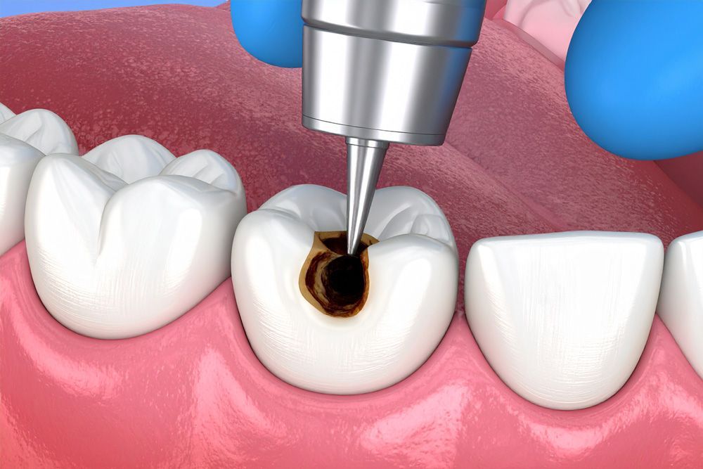 Tooth with a large cavity being drilled by a dental tool.